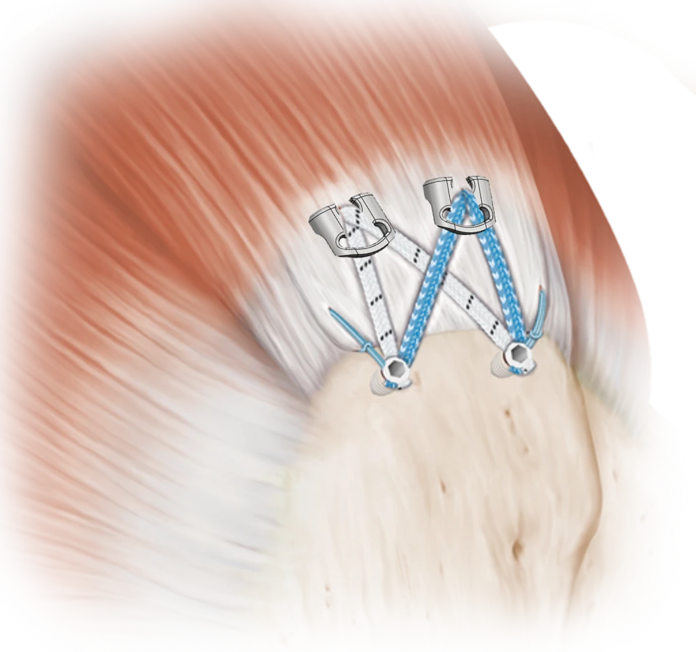 TENOGARDE™ eyelet implant in rotator cuff repair — anatomical view