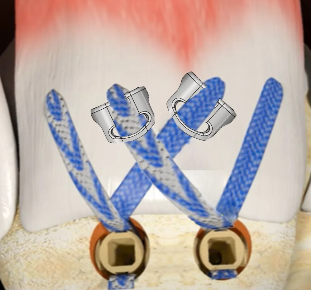 Single Row Repair with TENOGARDE™