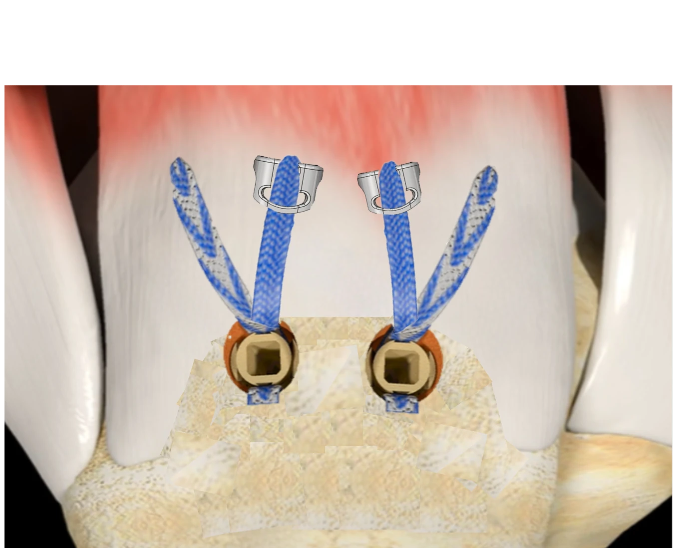 TENOGARDE™ front view with sutures