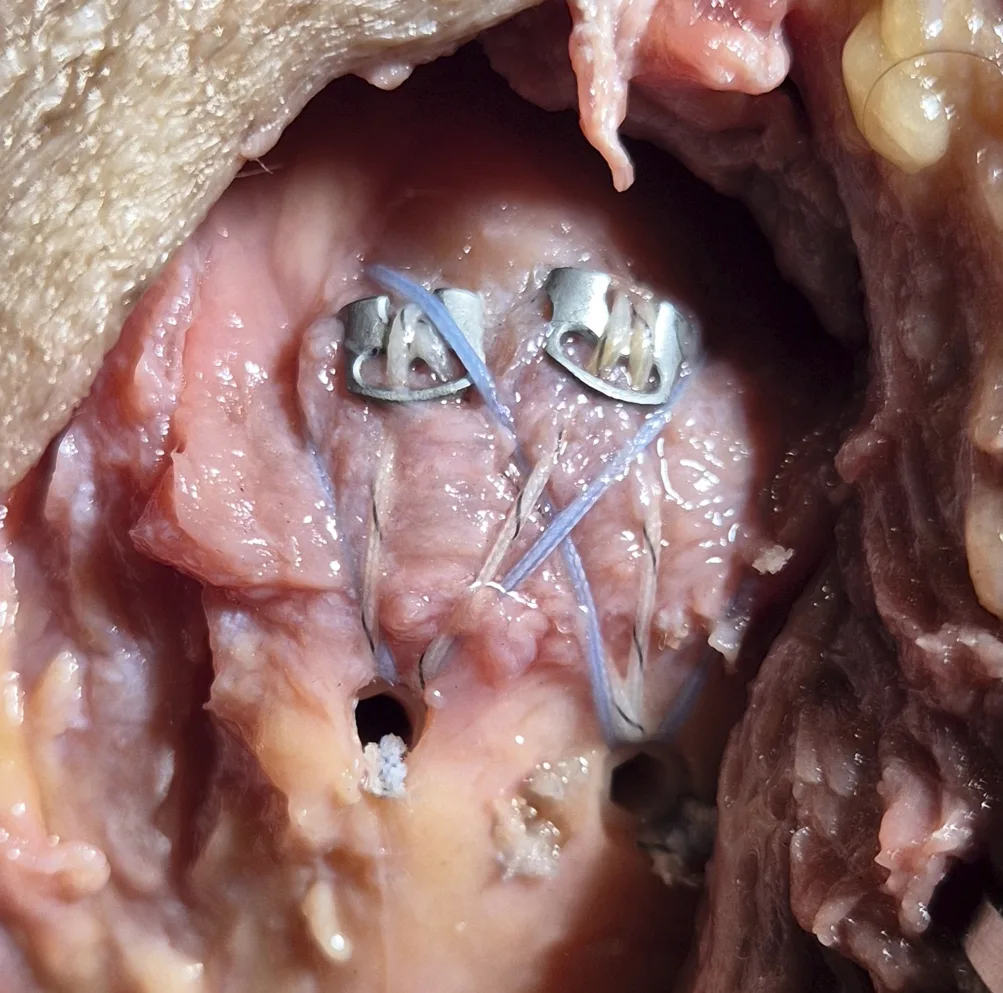 Massively Retracted Repair with TENOGARDE™