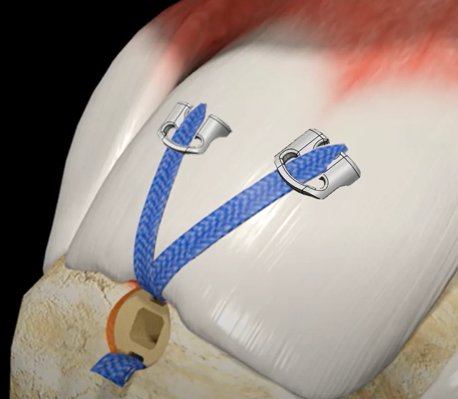 TENOGARDE™ side view with sutures