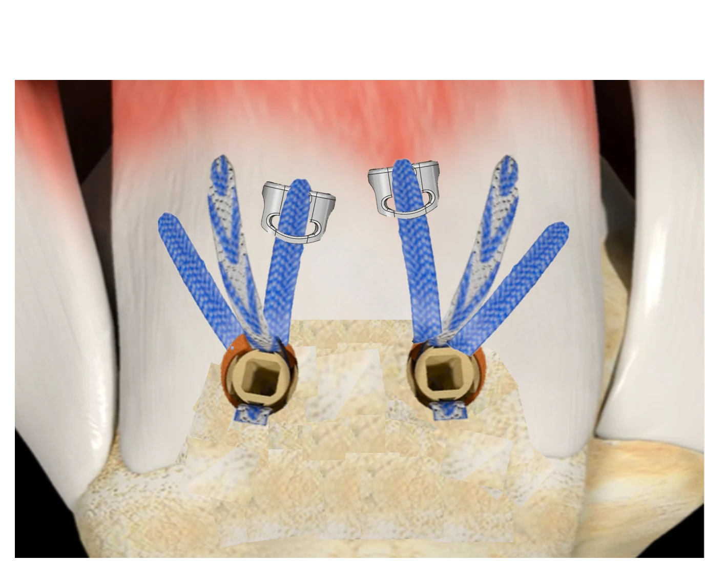 TENOGARDE™ wide surgical view